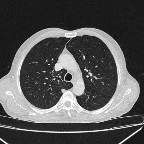 File:Azygos lobe (Radiopaedia 38259-40275 Axial lung window 27).jpg