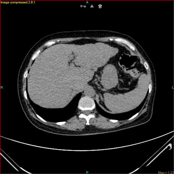 File:Azygos vein aneurysm (Radiopaedia 77824-90130 A 50).jpg