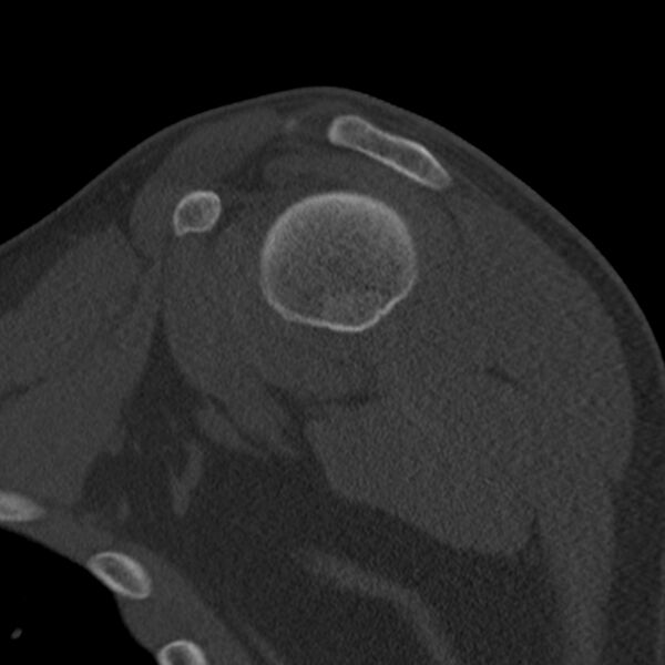 File:Bankart lesion (Radiopaedia 22771-22798 Sagittal bone window 22).jpg