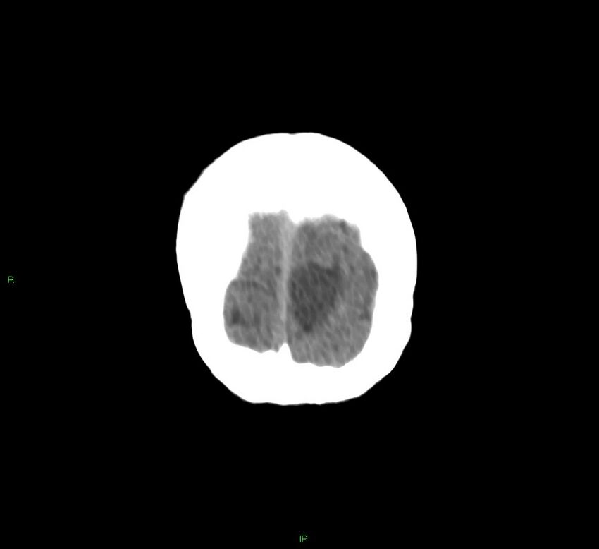 Basal ganglia hemorrhage (Radiopaedia 58766-65988 Coronal non-contrast 9).jpg