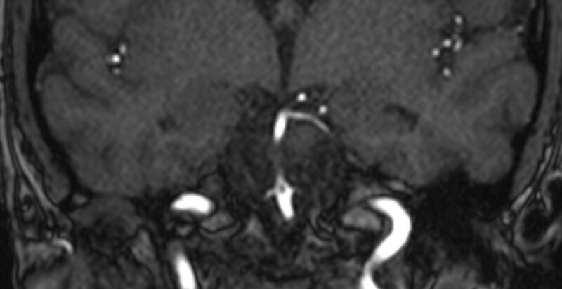 File:Basilar artery fenestration (Radiopaedia 74537-85455 Coronal MRA TOF 40).jpg
