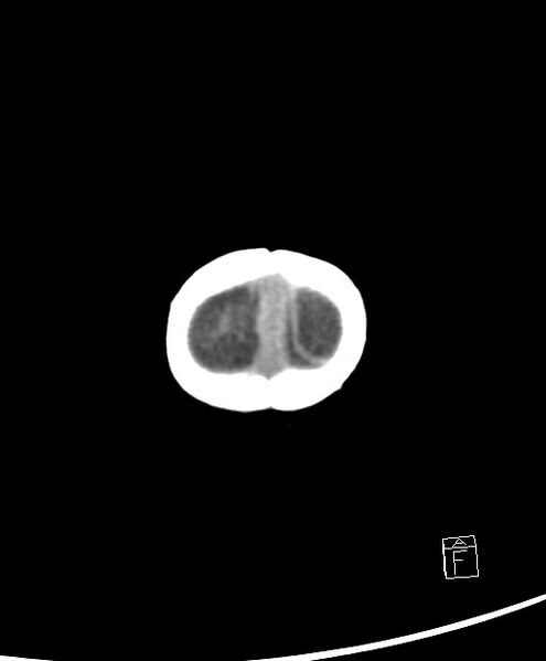 File:Benign enlargement of subarachnoid spaces in infancy (BESS) (Radiopaedia 87459-103795 Axial non-contrast 2).jpg