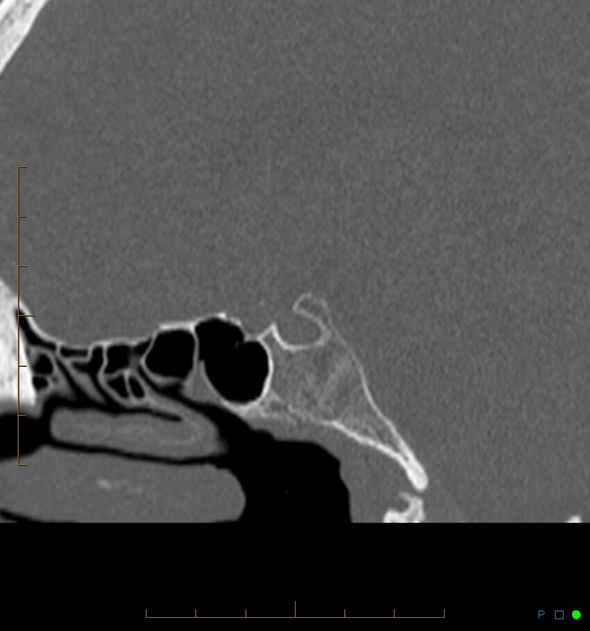 Benign notochordal cell tumor (probable) (Radiopaedia 65475-74546 Sagittal bone window 15).jpg