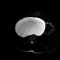 Benign seromucinous cystadenoma of the ovary (Radiopaedia 71065-81300 T2 SPAIR 21).jpg
