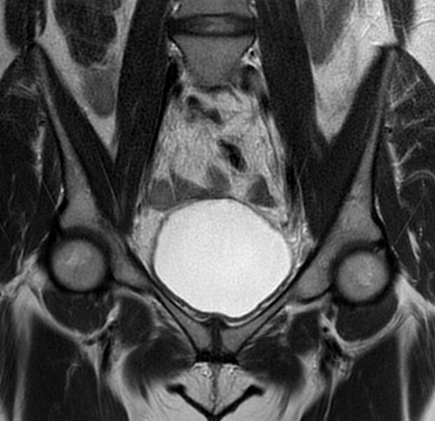 File:Bicornuate uterus (Radiopaedia 76407-88114 Coronal T2 6).jpg