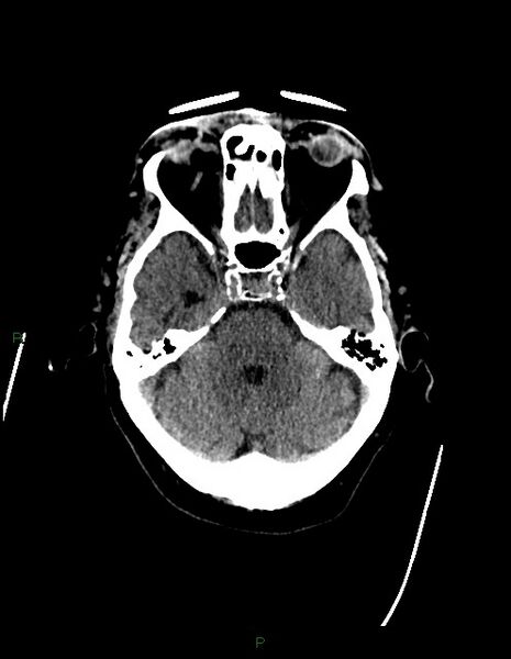 File:Bilateral acute middle cerebral artery territory infarcts (Radiopaedia 77319-89401 Axial non-contrast 25).jpg