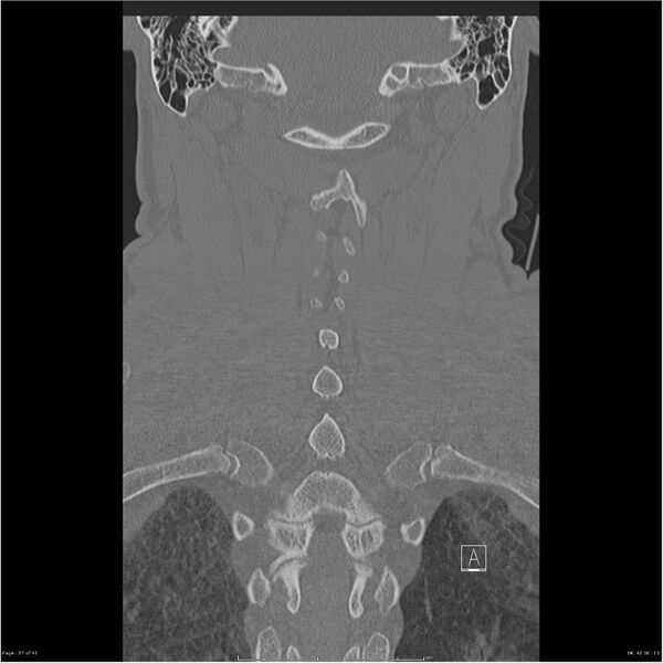 File:Bilateral cervical ribs (Radiopaedia 25868-26017 Coronal bone window 37).jpg