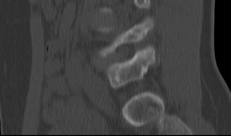 File:Bilateral pars defect (Radiopaedia 26691-26846 Sagittal bone window 43).jpg