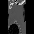 Bilateral perched facets with cord injury (Radiopaedia 45587-49713 Sagittal bone window 49).jpg