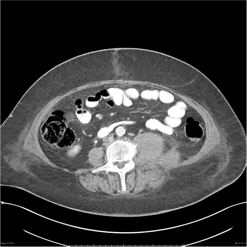 Bilateral psoas hematomas (Radiopaedia 24057-24279 A 47).jpg