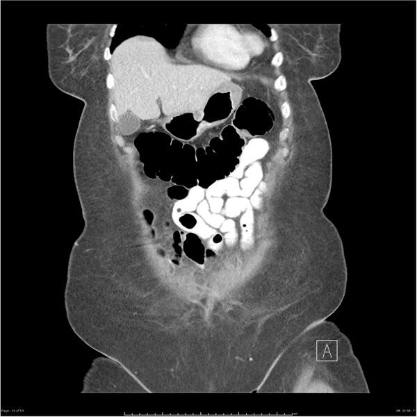 File:Bilateral psoas hematomas (Radiopaedia 24057-24279 B 14).jpg