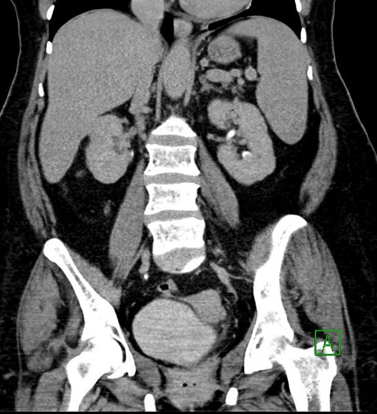 File:Bilateral sporadic synchronous clear cell renal cell carcinoma (Radiopaedia 85035-100575 I 35).jpg