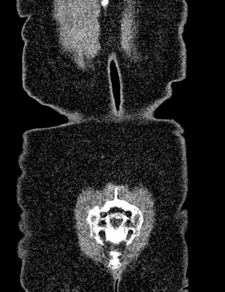 File:Bilateral staghorn calculi (Radiopaedia 59475-66842 Coronal non-contrast 92).jpg