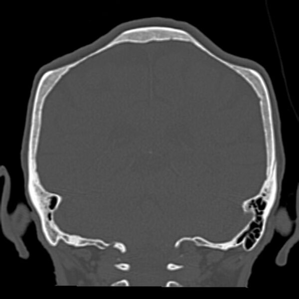 File:Biparietal osteodystrophy (Radiopaedia 46109-50463 Coronal bone window 73).jpg