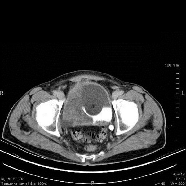 File:Bladder squamous cell carcinoma (Radiopaedia 14130-13984 C 9).jpg