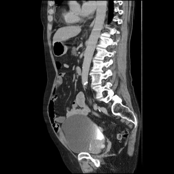 File:Bladder tumor detected on trauma CT (Radiopaedia 51809-57609 E 32).jpg