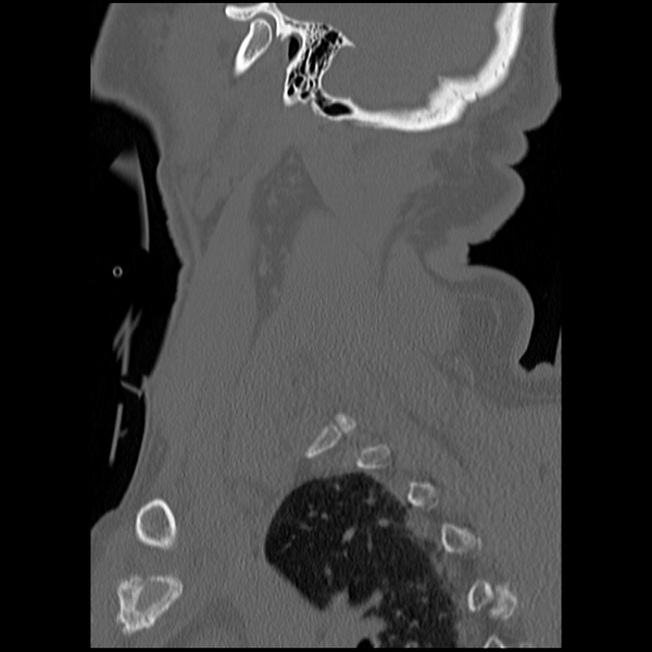 File:Blunt cerebrovascular injury (Radiopaedia 53682-59743 Sagittal bone window 22).png