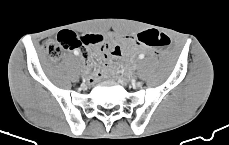 File:Blunt injury to the small bowel (Radiopaedia 74953-85987 A 148).jpg