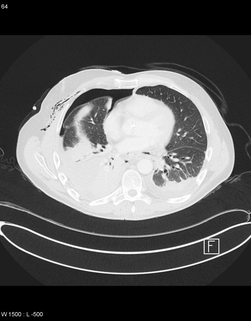 Boerhaave syndrome with tension pneumothorax (Radiopaedia 56794-63605 Axial lung window 31).jpg