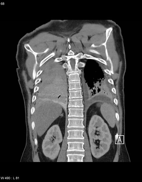 File:Boerhaave syndrome with tension pneumothorax (Radiopaedia 56794-63605 B 29).jpg