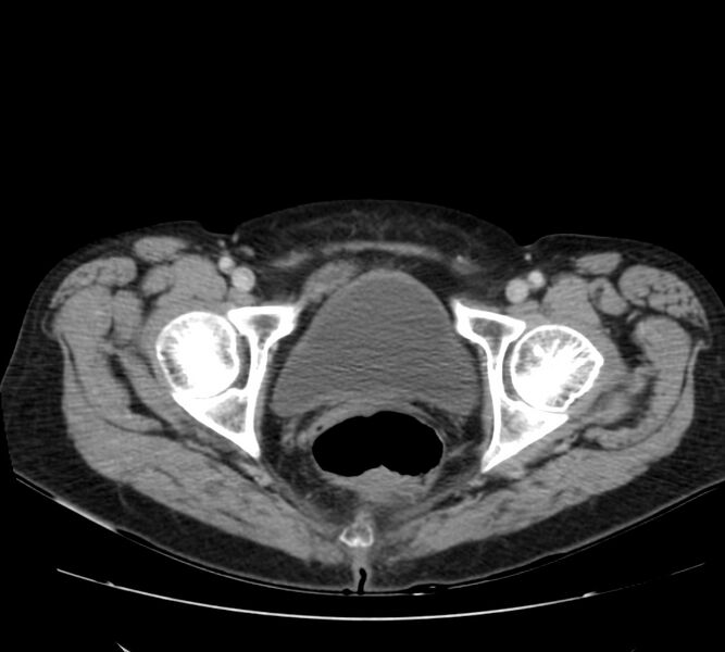 File:Bosniak renal cyst - type IV (Radiopaedia 22929-22953 C 65).jpg