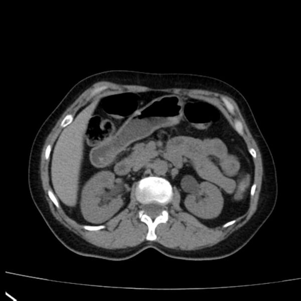 File:Bosniak renal cyst - type I (Radiopaedia 27479-27675 Axial non-contrast 33).jpg