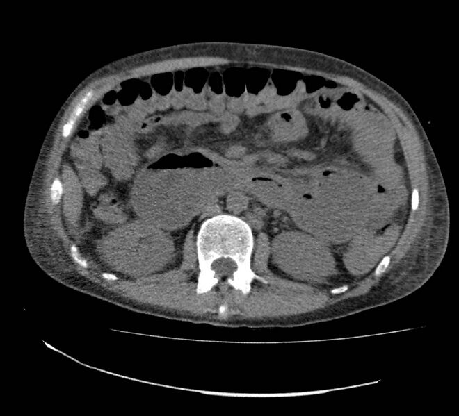 File:Bowel lymphoma complicated by bleeding after therapy (Radiopaedia 55601-62110 Axial non-contrast 35).jpg