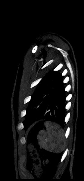 File:Brachiocephalic trunk pseudoaneurysm (Radiopaedia 70978-81191 C 81).jpg