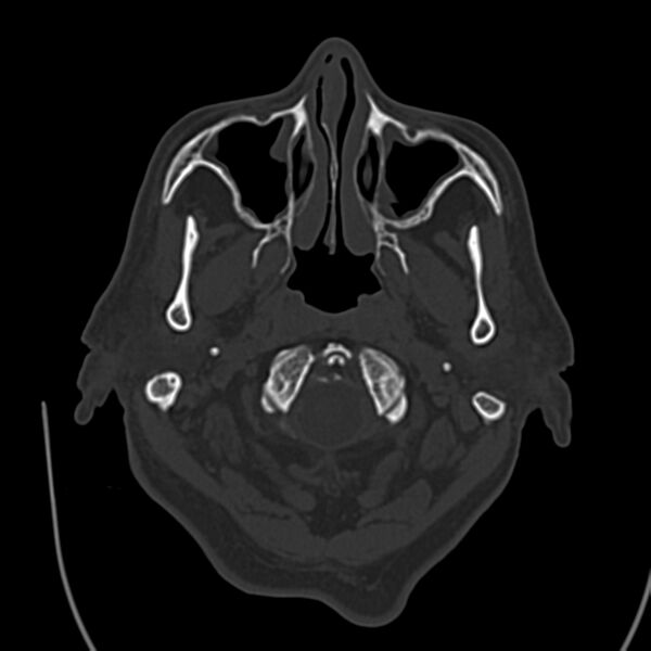 File:Brain Pantopaque remnants (Radiopaedia 78403-91048 Axial bone window 12).jpg