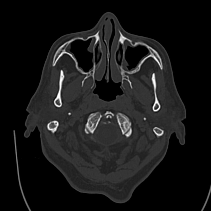 Brain Pantopaque remnants (Radiopaedia 78403-91048 Axial bone window 12).jpg