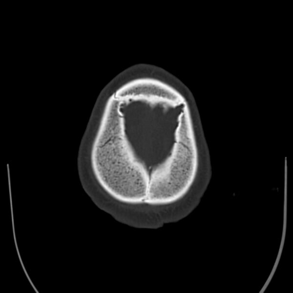 File:Brain Pantopaque remnants (Radiopaedia 78403-91048 Axial bone window 63).jpg