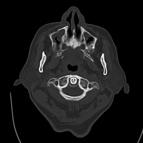 File:Brain Pantopaque remnants (Radiopaedia 78403-91048 Axial bone window 7).jpg
