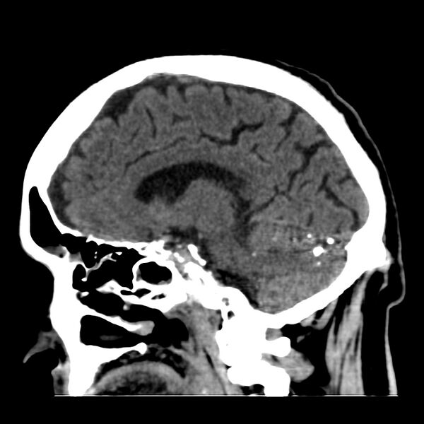 File:Brain Pantopaque remnants (Radiopaedia 78403-91048 C 25).jpg