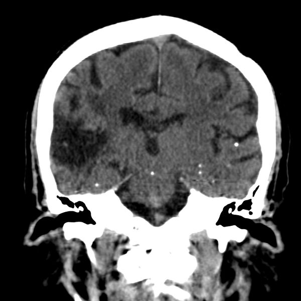 File:Brain Pantopaque remnants (Radiopaedia 78403-91048 Coronal non-contrast 40).jpg