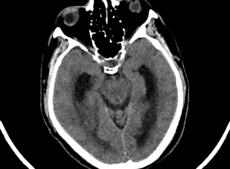 File:Brain abscess complicated by intraventricular rupture and ventriculitis (Radiopaedia 82434-96575 Axial non-contrast 15).jpg