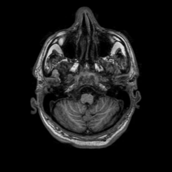 File:Brain abscess complicated by intraventricular rupture and ventriculitis (Radiopaedia 82434-96577 Axial T1 8).jpg