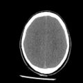 Brain death (Radiopaedia 78597-91360 Axial non-contrast 44).jpg