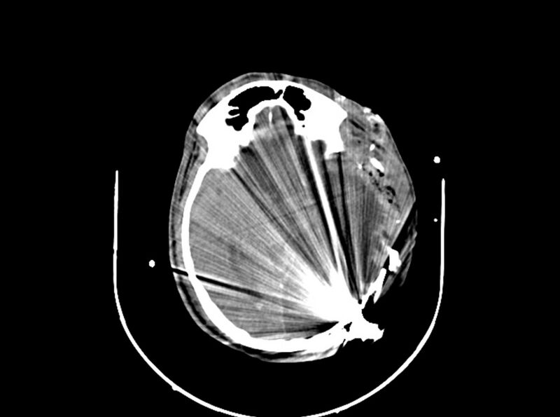 File:Brain injury by firearm projectile (Radiopaedia 82068-96087 B 97).jpg