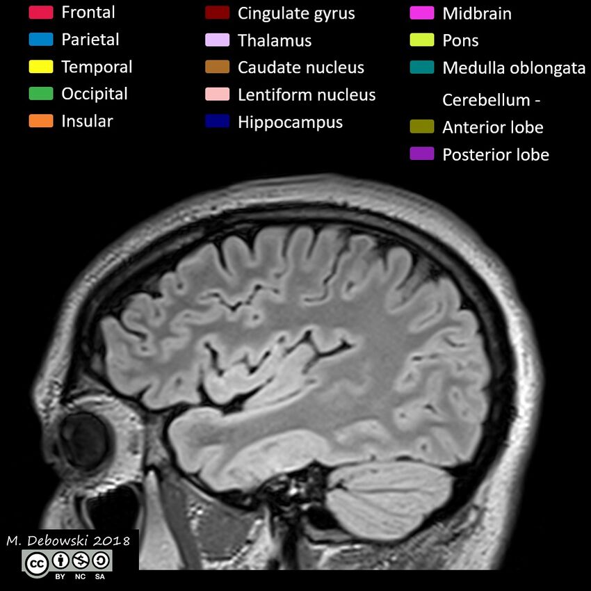 Brain lobes - annotated MRI (Radiopaedia 61691-69700 Sagittal 16).JPG
