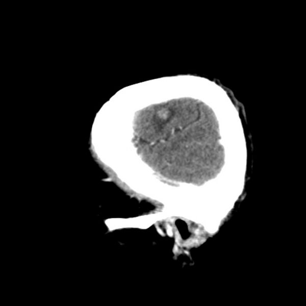 File:Brain metastases from lung cancer (Radiopaedia 24480-24781 C+ delayed 7).jpg