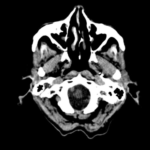 File:Brain metastases from lung cancer (Radiopaedia 27849-28092 Axial non-contrast 5).jpg
