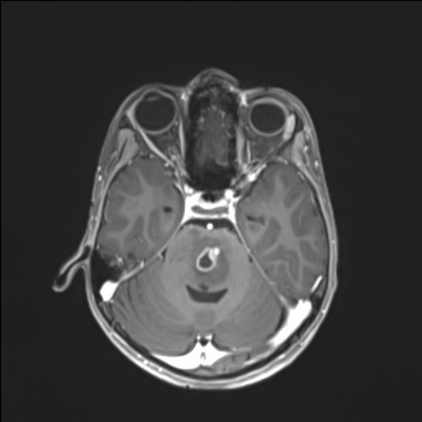 Brainstem glioma (Radiopaedia 70548-80674 Axial T1 C+ 55).jpg