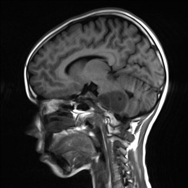 File:Brainstem glioma (Radiopaedia 70548-80674 Sagittal T1 14).jpg