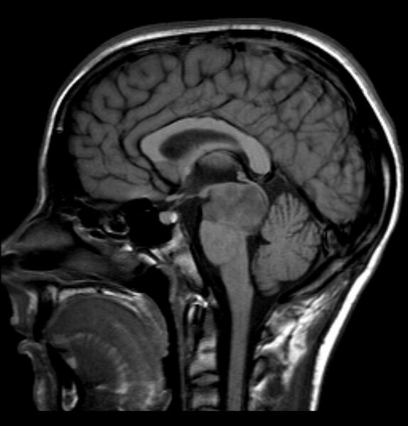 File:Brainstem glioma - focal midbrain (Radiopaedia 6525-7840 Sagittal T1 1).jpg