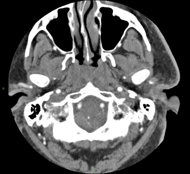 File:Brainstem hemorrhage (Radiopaedia 58794-66028 D 24).jpg