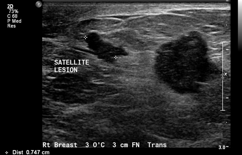 File:Breast cancer and multiple circumscribed masses (Radiopaedia 62456-70700 A 5).jpeg