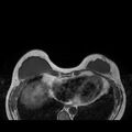 Breast implants - MRI (Radiopaedia 26864-27035 Axial T1 14).jpg