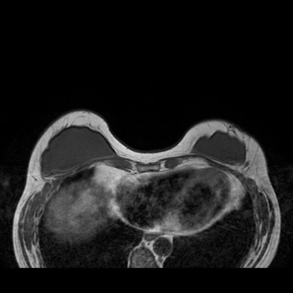 File:Breast implants - MRI (Radiopaedia 26864-27035 Axial T1 14).jpg