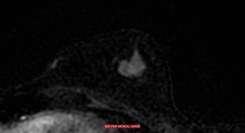 File:Breast lymphoma (MRI) (Radiopaedia 34999-36498 C 17).jpg