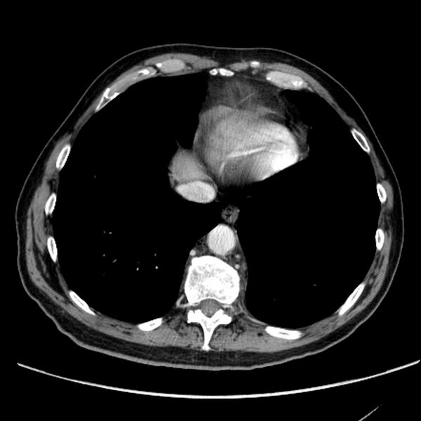 File:Bronchogenic carcinoma with L1 vertebra metastasis (Radiopaedia 9096-9805 Axial C+ delayed 27).jpg